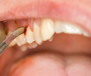 Diş Eti Kanaması önlemleri